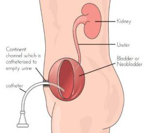 mitrofanoff-diagram1